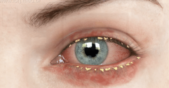 Como a blefarite afeta os olhos – Donato Hospital de Olhos