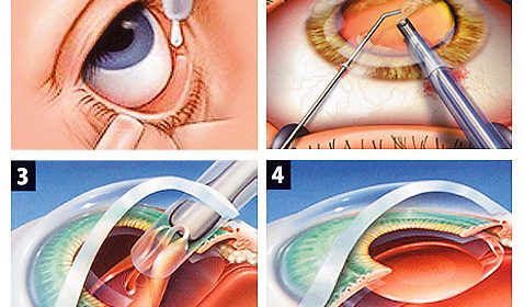 3 formas de tratamento para o terçol – Hospital de Olhos